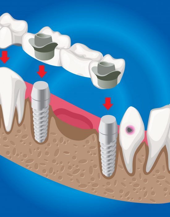 Isometric prosthetic dentistry concept with dental bridge used for missing teeth covering isolated vector illustration SSUCv3H4sIAAAAAAACA02RT0/DMAzFv0rkc2Egbr1P/JEQExwnDm5iWm9pMiVuxzT1u+N0rcQttp/es3+5QoOZLdRXYO+HLAmFY4D6sQJyLDExeqgfpgqyoAyZsmq1sijU6nSuV5P9tfShhhdCL53FRJt3tbHqoQZDo6OP5kBWMkzVKl47q+I1R6/uDqbvCrClYC8lU0MTecJ5hb2Ojmeh1C/7jOwo3p44OC5PGKMG6/yp7Ku3xb5024Snjm3ikVKpHWWbbrE9SWJrTilm6Uj06SgIK5WLsTFYOok5s3RzG71pEruWjFJx5icm03POHFojRCqyURNKyctBZtQ7Vfaf9L3ZKmZsPJnt7stgcOaTgiNVBfO2ey6+vWKqQH4LLKgWajevvFn2GtBvupn6XV+IcyCVxqP+5DRNfzV3PGTnAQAA